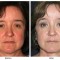 Orange County Cosmetic Surgery Clinique Before & After Forehead Lift 3 - Front