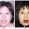 Orange County Cosmetic Surgery Clinique Before & After Forehead Lift 4