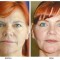 Orange County Cosmetic Surgery Clinique Before & After Forehead Lift 5