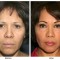 Orange County Cosmetic Surgery Clinique Before & After Forehead Lift 6