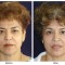 Orange County Cosmetic Surgery Clinique Before & After Forehead Lift 7