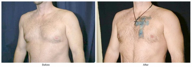 Orange County Cosmetic Surgery Clinique Before & After Gynecomastia 1 - Left Quarter