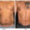 Orange County Cosmetic Surgery Clinique Before & After Liposuction 3 - Front