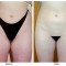 Orange County Cosmetic Surgery Clinique Before & After Liposuction 4 - Front