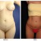 Orange County Cosmetic Surgery Clinique Before & After Liposuction 5 - Front