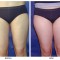 Orange County Cosmetic Surgery Clinique Before & After Liposuction 6 - Front