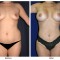 Orange County Cosmetic Surgery Clinique Before & After Liposuction 7 - Front