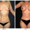 Orange County Cosmetic Surgery Clinique Before & After Mommy Makeover 4 - Front