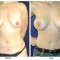 Orange County Cosmetic Surgery Clinique Before & After Mommy Makeover 5 - Front