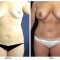 Orange County Cosmetic Surgery Clinique Before & After Mommy Makeover 6 - Front