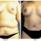 Orange County Cosmetic Surgery Clinique Before & After Mommy Makeover 7 - Front