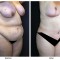 Orange County Cosmetic Surgery Clinique Before & After Mommy Makeover 8 - Right Quarter