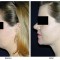 Orange County Cosmetic Surgery Clinique Before & After Neck Lift 1