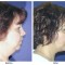 Orange County Cosmetic Surgery Clinique Before & After Neck Lift 2 - Right