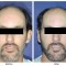 Orange County Cosmetic Surgery Clinique Before & After Otoplasty 1