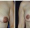 Orange County Cosmetic Surgery Clinique Before & After Periareolar Lift 2 - Front