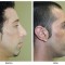 Orange County Cosmetic Surgery Clinique Before & After Rhinoplasty 12 - Right