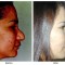 Orange County Cosmetic Surgery Clinique Before & After Rhinoplasty 14 - Right