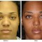 Orange County Cosmetic Surgery Clinique Before & After Rhinoplasty 15 - Front