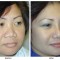 Orange County Cosmetic Surgery Clinique Before & After Rhinoplasty 16 - Right Quarter