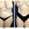 Orange County Cosmetic Surgery Clinique Before & After Tummy Tuck 10 - Front