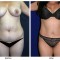 Orange County Cosmetic Surgery Clinique Before & After Tummy Tuck 11 - Front