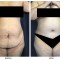 Orange County Cosmetic Surgery Clinique Before & After Tummy Tuck 7 - Front