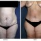 Orange County Cosmetic Surgery Clinique Before & After Tummy Tuck 8 - Front