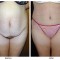 Orange County Cosmetic Surgery Clinique Before & After Tummy Tuck 9 - Front